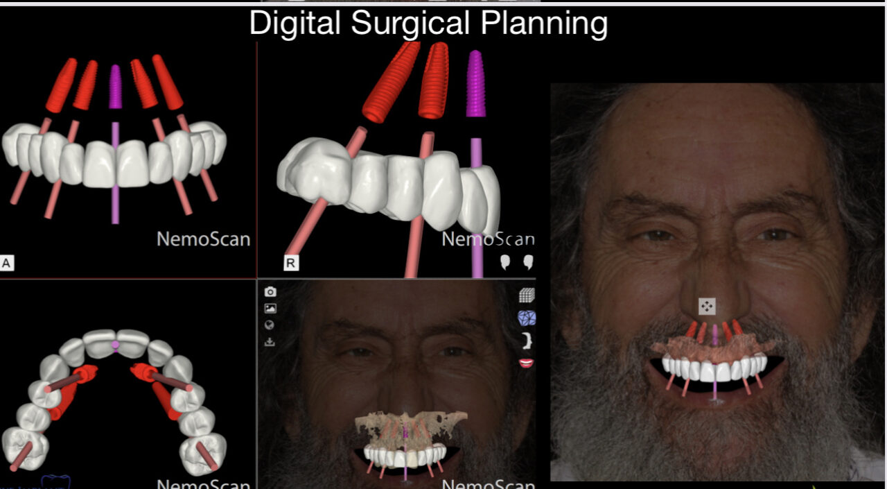 Full Arch Surgical And Prosthetic Training Utilizing Digital Workflow ...